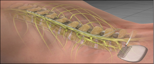 Spinal Cord Stimulation  Cincinnati, OH Mayfield Brain & Spine